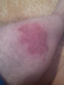 red spot on leg, psoriasis