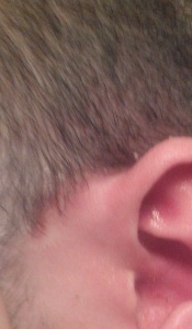 psoriasis around the ears