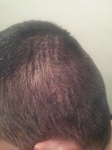 psoriasis, scalp, hair