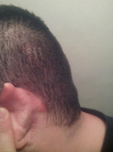 psoriasis scalp, ears
