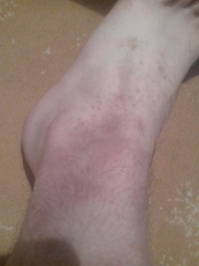 psoriasis on ankles