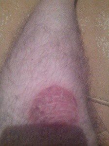 psoriasis on knee